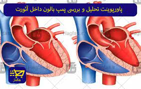 آشنایی با بالن پمپ داخل آئورت و نحوه کار آن (ppt) 38 اسلاید